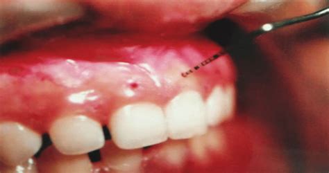 gingival thickness measurement|gingival attachment thickness.